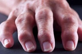 Les principales différences entre l'arthrite et l'arthrose