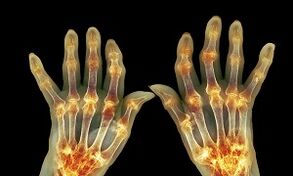 Quelle est la différence entre l'arthrite due à l'arthrose des articulations