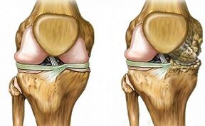 Signe de différenciation d'une arthrose articulaire